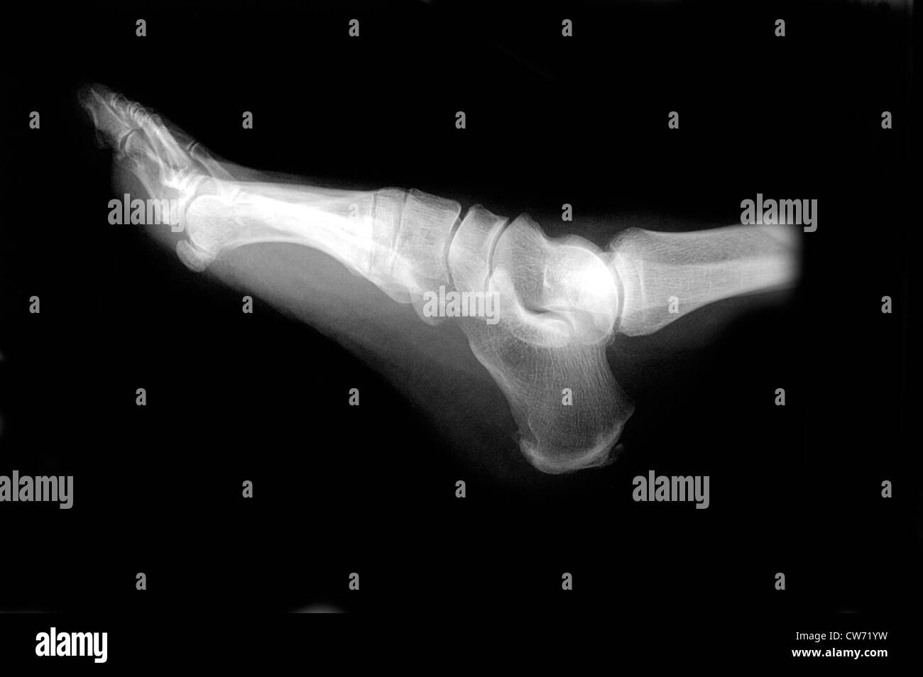 X-ray foto di un piede Foto Stock