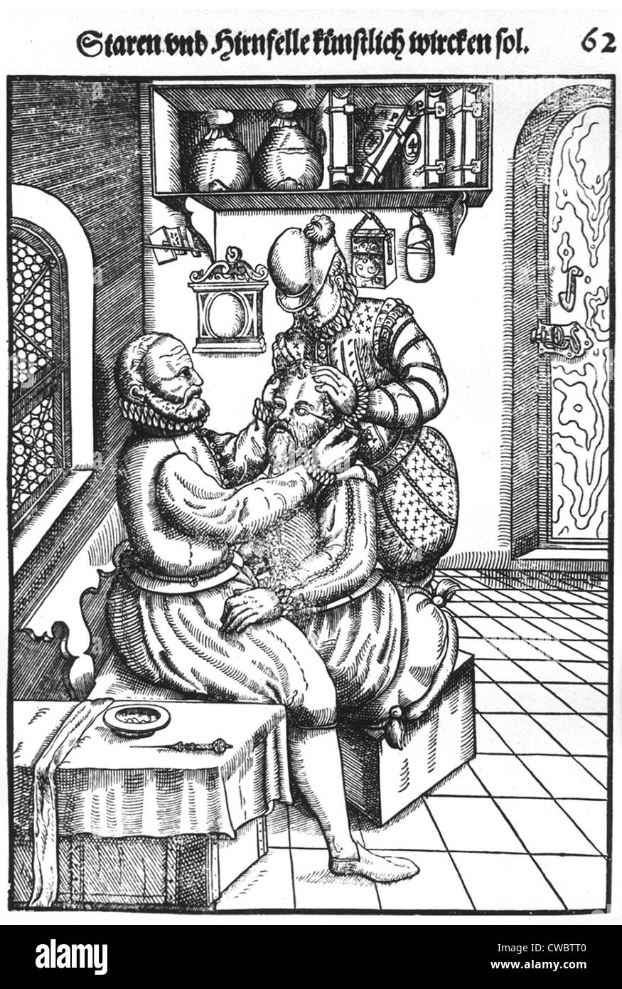 Paziente avente una cataratta rimosso dal suo occhio sinistro da un chirurgo cui assistant immobilizzare il paziente. Xilografia da Foto Stock