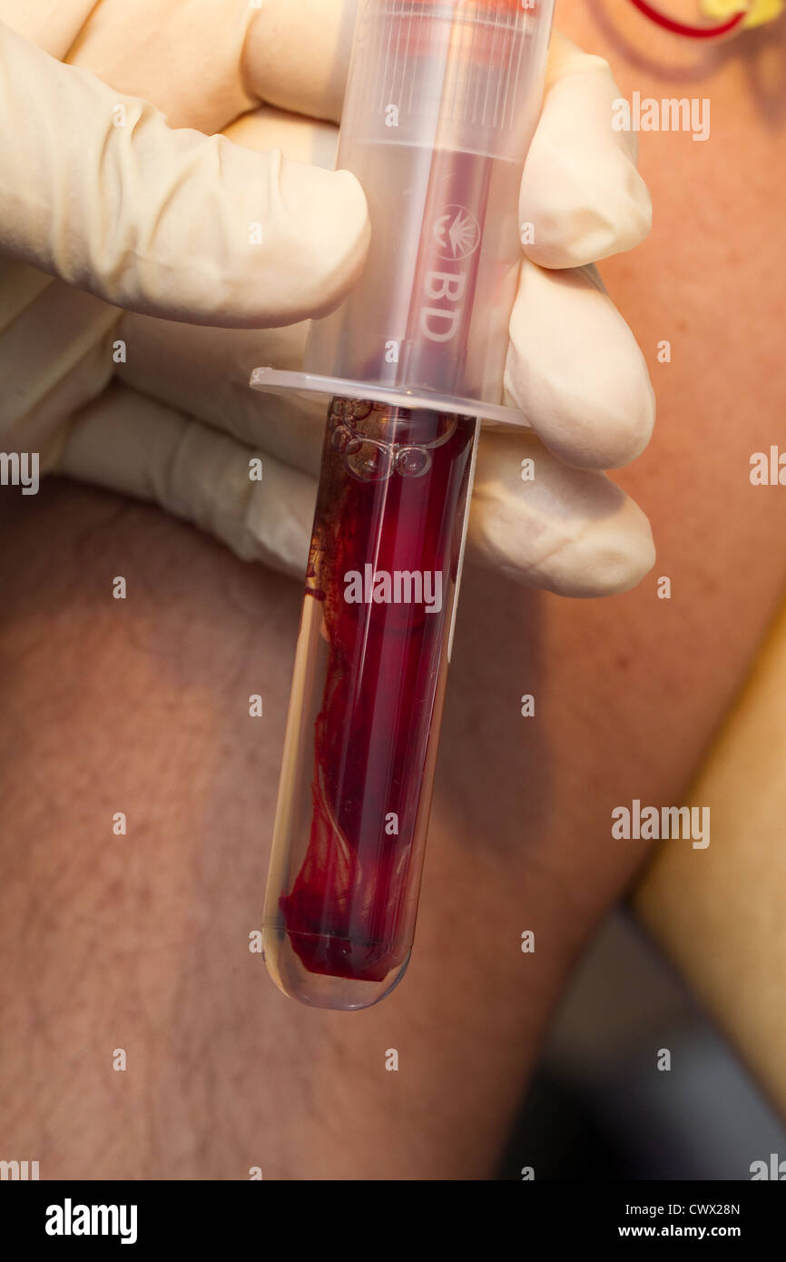 Analisi del sangue Foto Stock