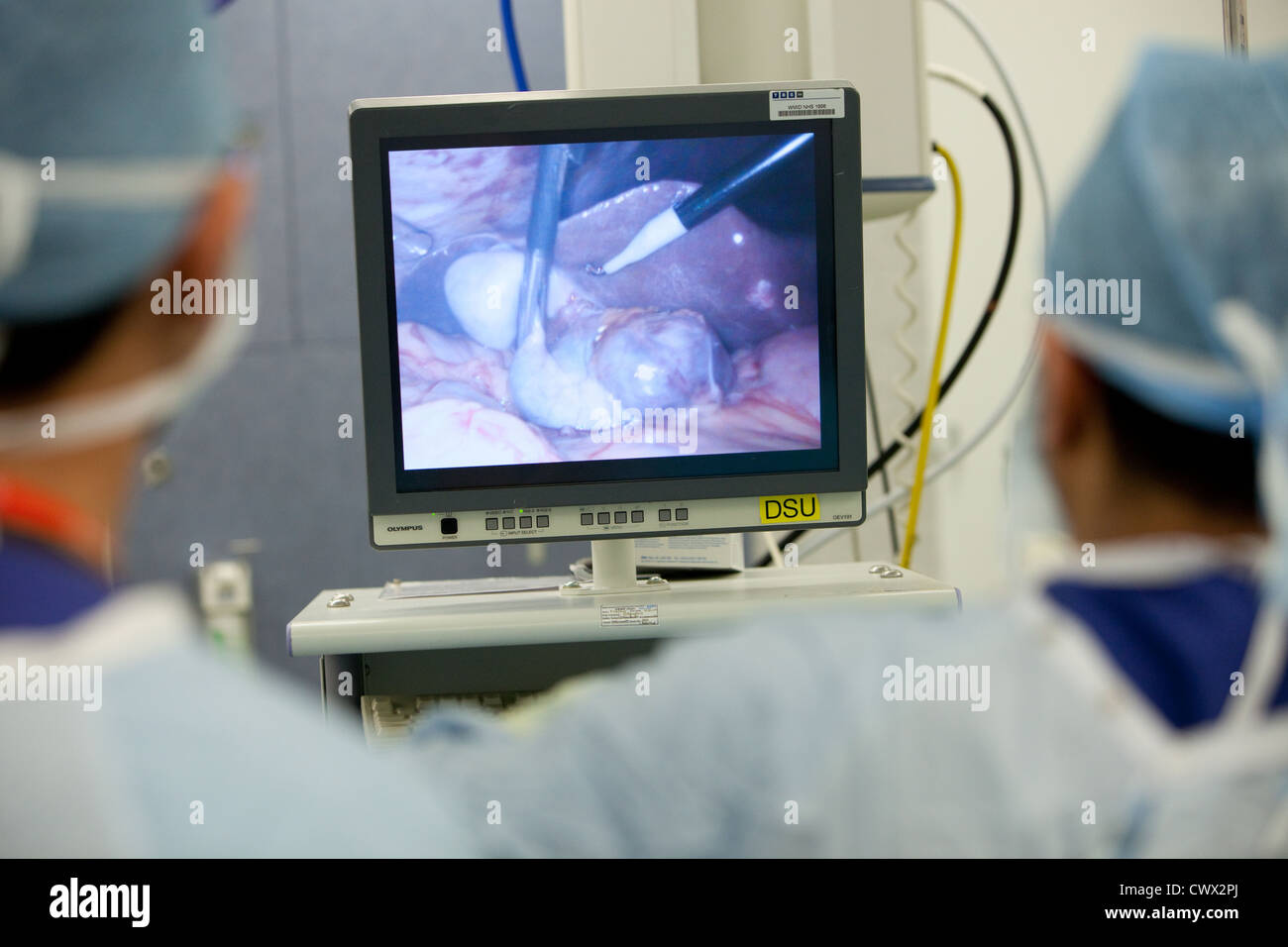 La chirurgia laparoscopica per rimuovere un cistifellea Foto Stock