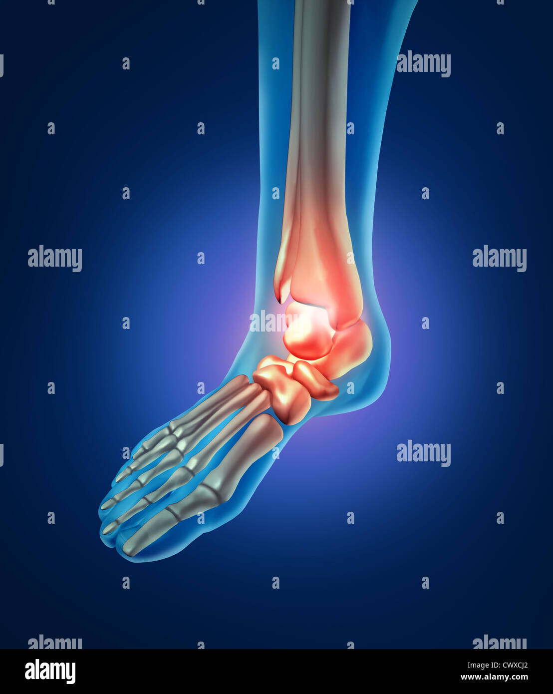 Il dolore del piede con uno scheletro del corpo a piedi parte con le ossa in rosso dove trhere è infiammazione della caviglia che ha un giunto orthoedic pregiudizio causato y bad scarpe o esecuzione di incidente. Foto Stock