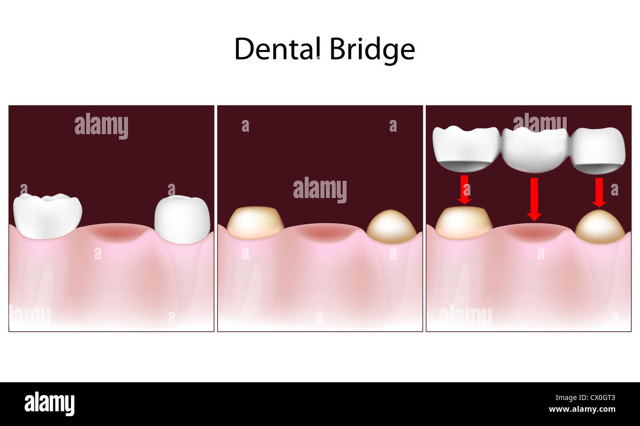 Ponte dentale procedura Foto Stock