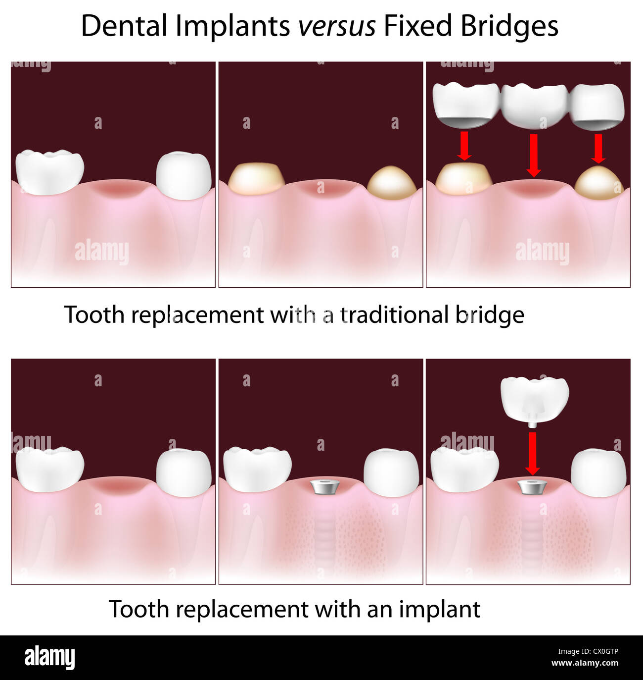 Gli impianti dentali rispetto ai tradizionali ponti fissi Foto Stock