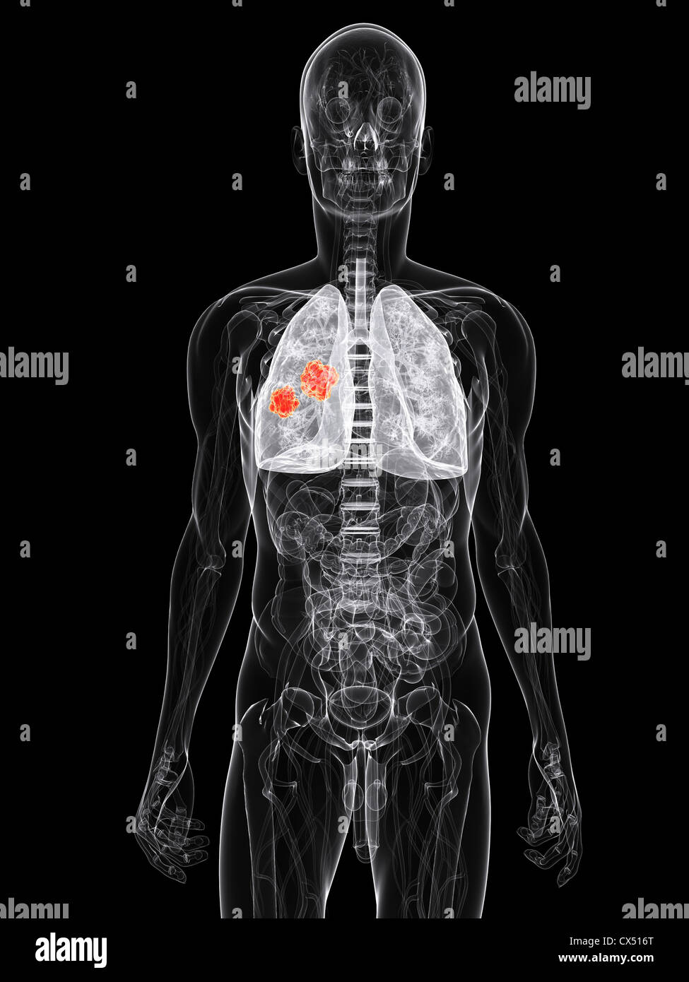 Cancro del polmone Foto Stock