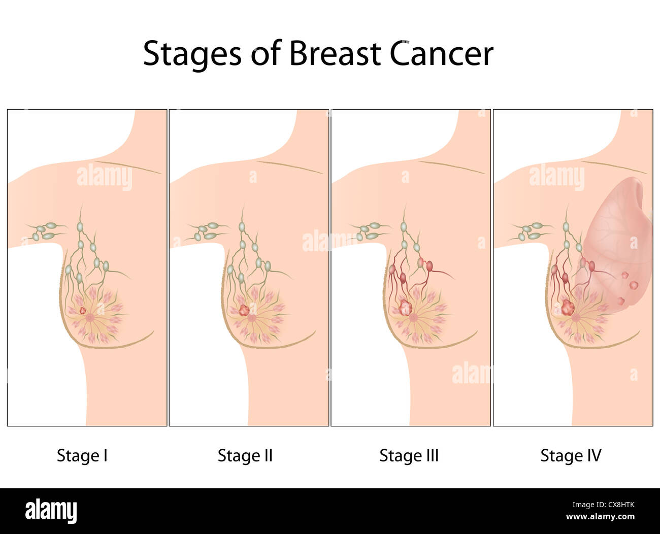 Fasi del cancro della mammella Foto Stock