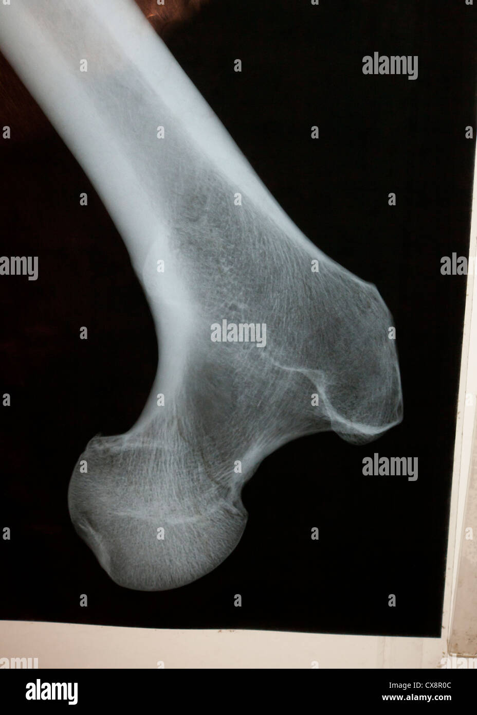 X-ray di osso femore Foto Stock