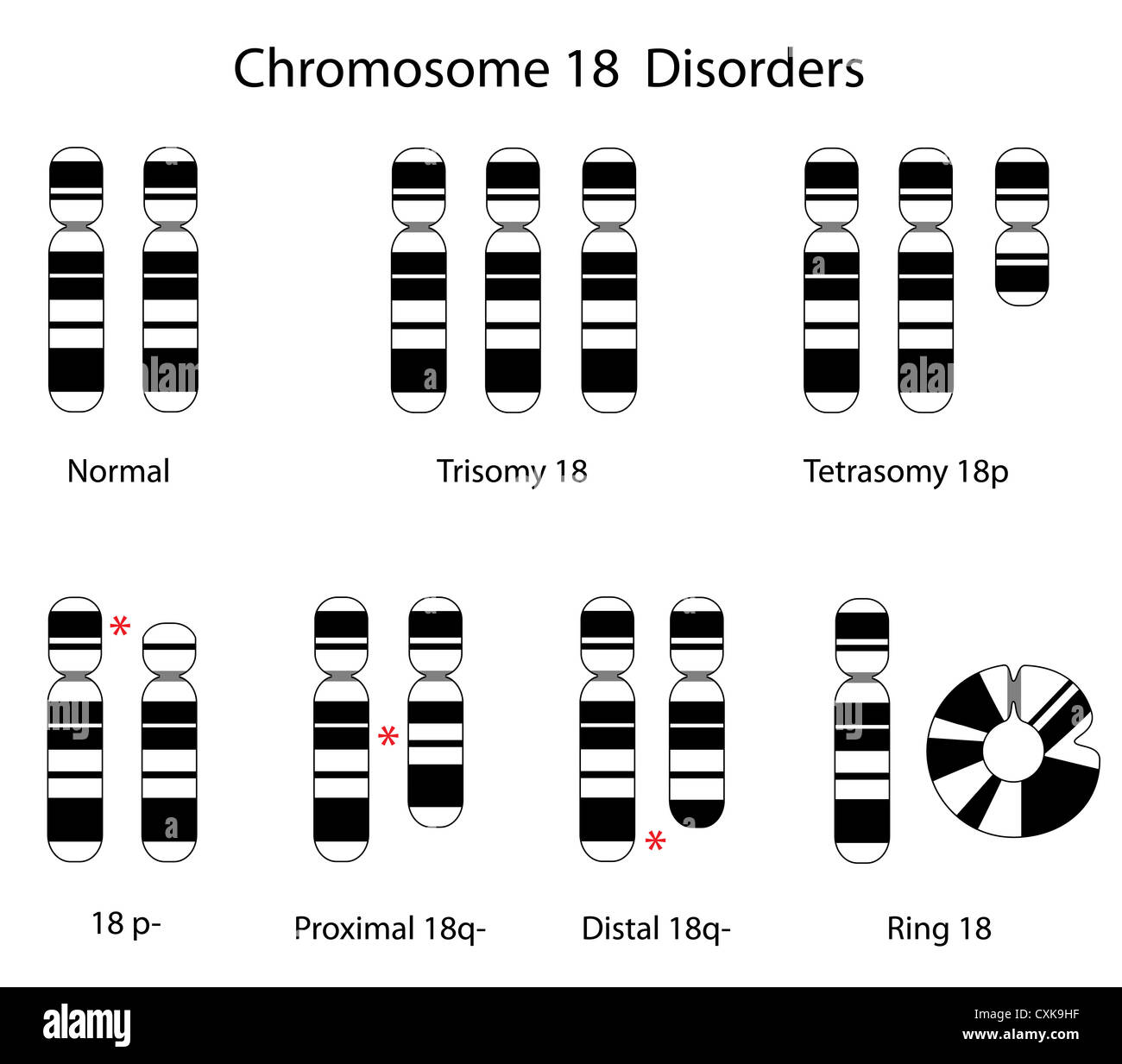Il cromosoma 18 disturbi Foto Stock