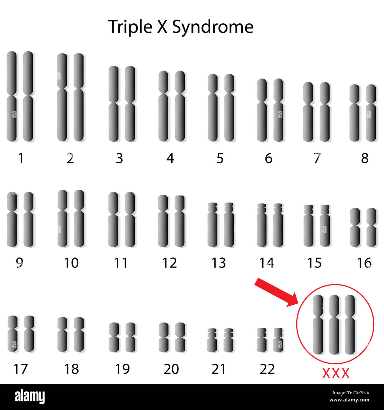 Tripla della sindrome x Foto Stock