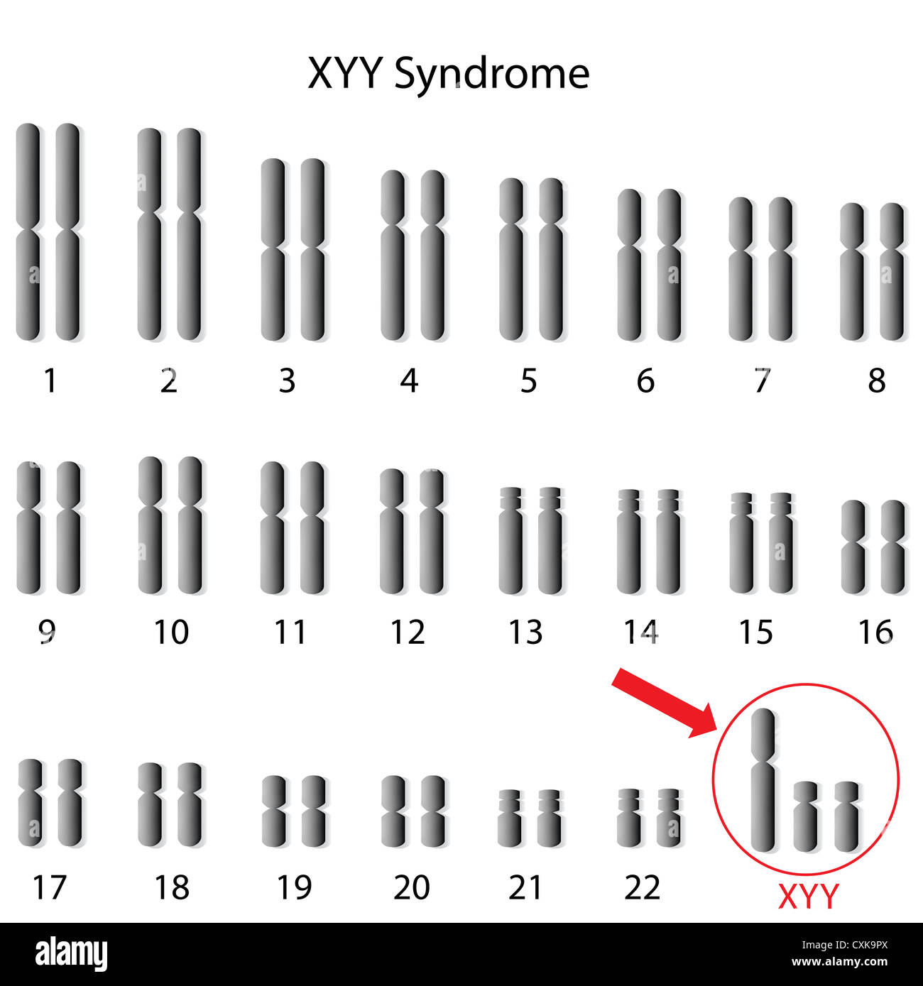 XYY, Super maschio genoma sindrome Foto Stock