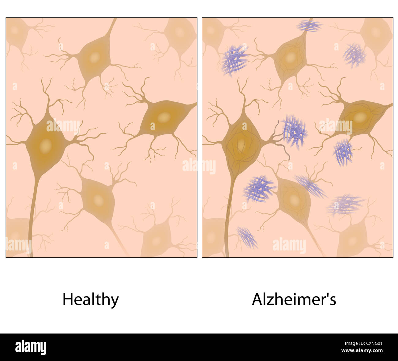 La malattia di Alzheimer il tessuto cerebrale con l'amiloide Foto Stock