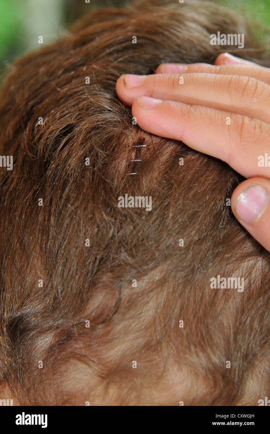 Il retro di un ragazzi testa con punti metallici in esso di guarire una ferita. Foto Stock