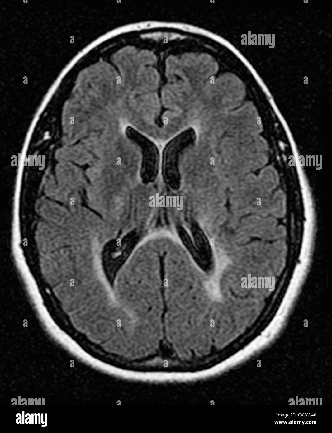 MRI di sclerosi multipla in un anno 42 vecchia donna Foto Stock