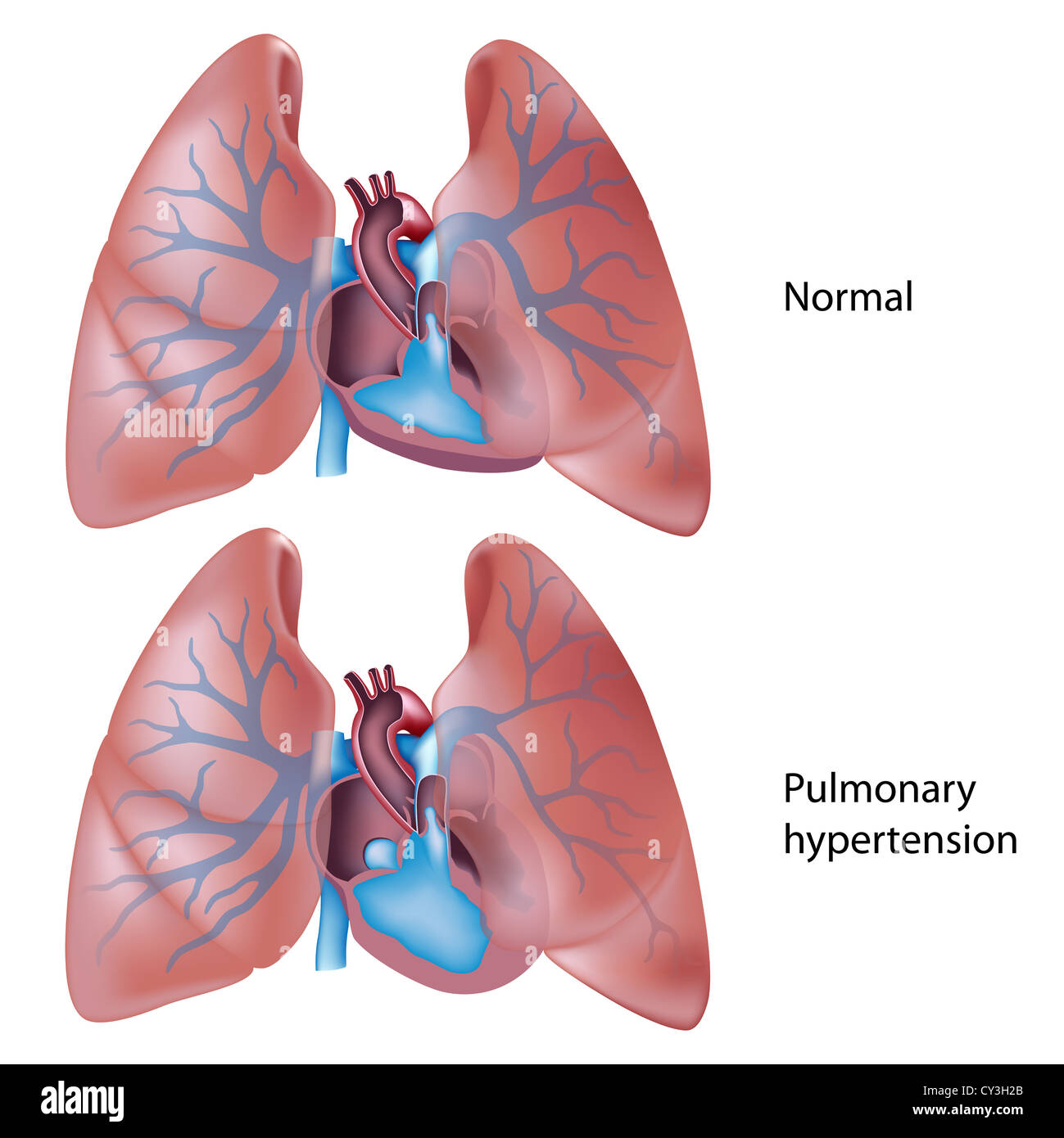 Ipertensione polmonare Foto Stock