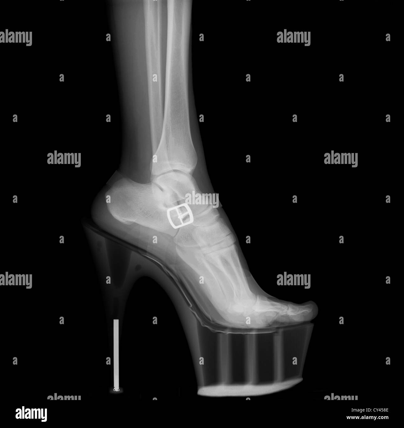 Raggi X di una donna che indossa la gamba Stiletto High-Heeled Scarpa Foto Stock