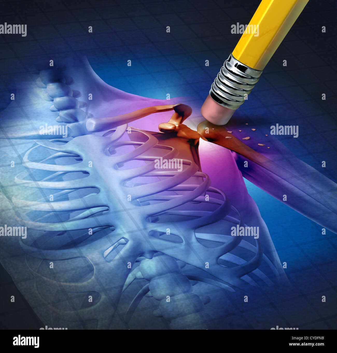 Spalla umana sollievo dal dolore con una x-ray di anatomia del corpo con l'area dolorosa che vengono cancellati da una matita come una salute cura medica di simbolo di trattamento per una malattia cronica causata da infortunio o artrite come una articolazione di scheletro di cura. Foto Stock