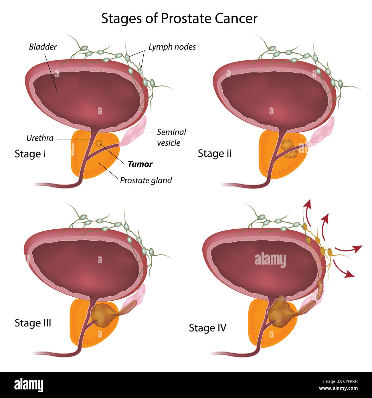 Stadi del cancro della prostata Foto Stock