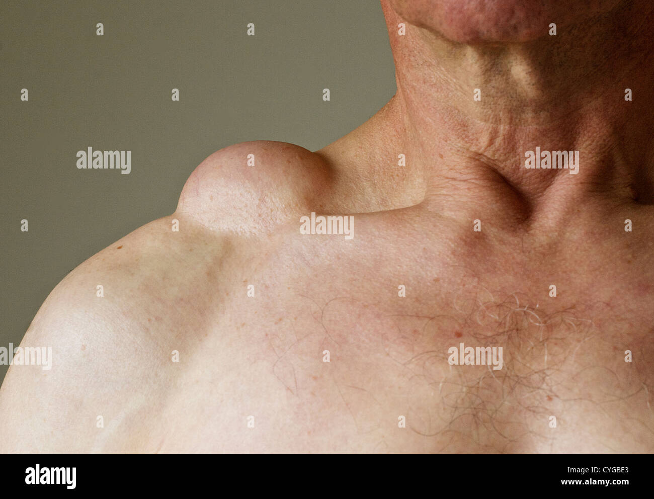 Un lipoma su un maschio di spalla. Un lipoma è un tumore benigno o grumo di grassi, consistente di un tessuto morbido e non maligne. Foto Stock