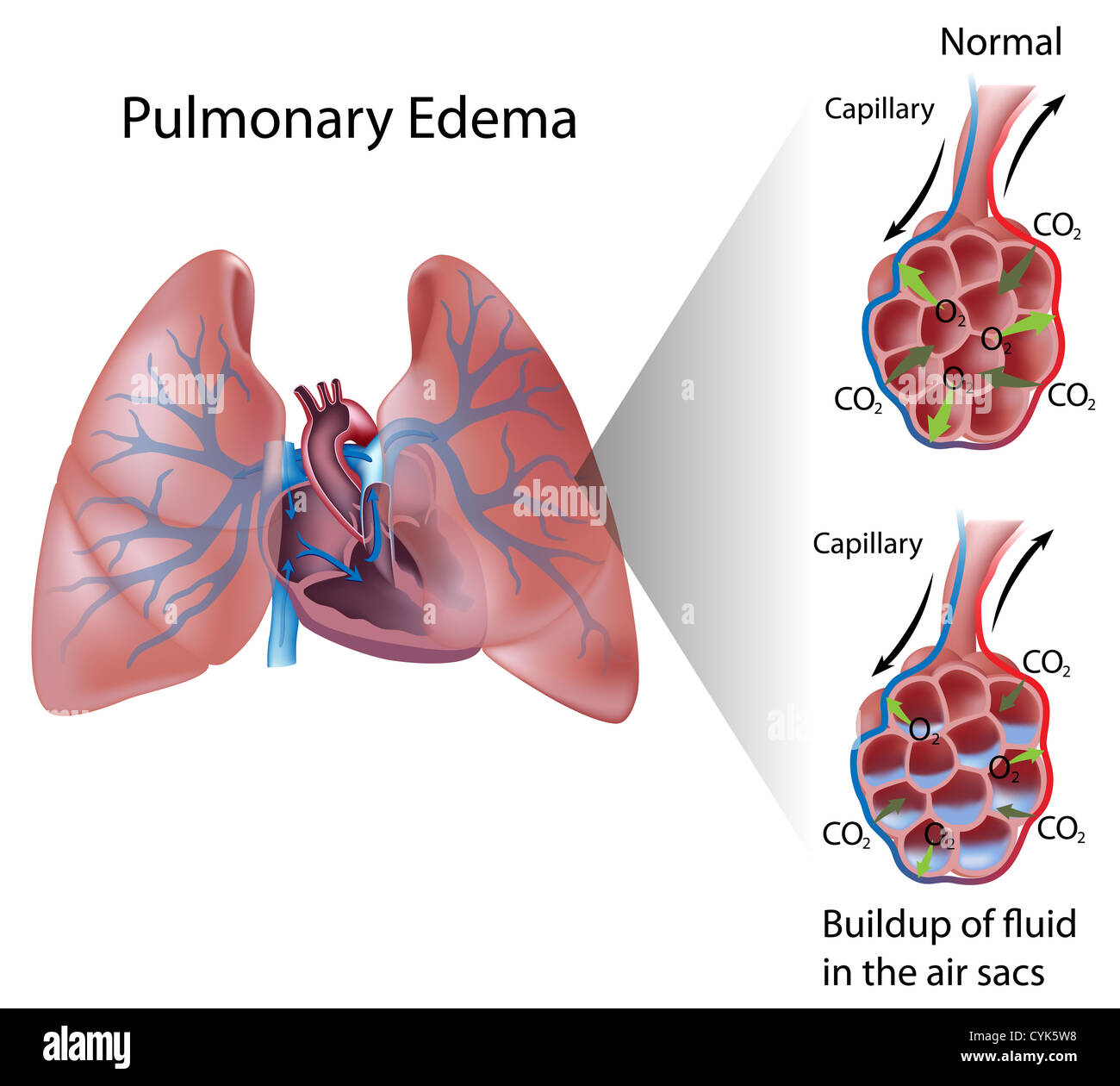 Edema polmonare Foto Stock