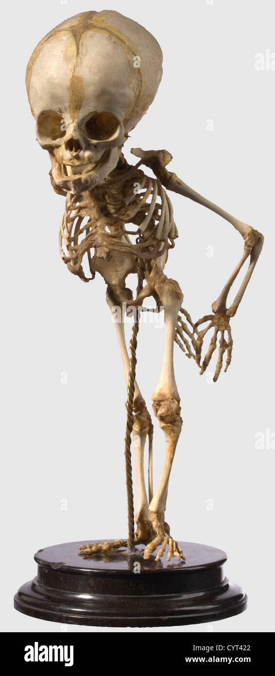 Uno scheletro tedesco preparato per studi patologici o anatomici, elaborato del XIX secolo, scheletro completo di un neonato con grave deformazione della colonna vertebrale. Colonna vertebrale aperta chiaramente marcata (spina bifida) insieme con forte curvatura spinale (scoliosi). Montato su una base a gradini di serpentina nera. La base è leggermente ammaccata. Vi è anche una campana di vetro con un legno Base su tre piedi palla.altezza dello scheletro 39 cm.altezza con la campana di vetro: 69 cm.raro, preparazione di alta qualità da una collezione per l'istruzione scientifica.lo scheletro,Additional-Rights-Clearences-non disponibile Foto Stock