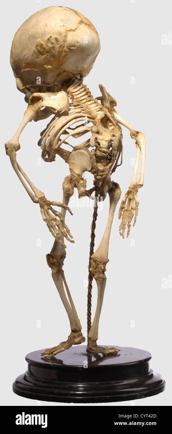 Uno scheletro tedesco preparato per studi patologici o anatomici, elaborato del XIX secolo, scheletro completo di un neonato con grave deformazione della colonna vertebrale. Colonna vertebrale aperta chiaramente marcata (spina bifida) insieme con forte curvatura spinale (scoliosi). Montato su una base a gradini di serpentina nera. La base è leggermente ammaccata. Vi è anche una campana di vetro con un legno Base su tre piedi palla.altezza dello scheletro 39 cm.altezza con la campana di vetro: 69 cm.raro, preparazione di alta qualità da una collezione per l'istruzione scientifica.lo scheletro,Additional-Rights-Clearences-non disponibile Foto Stock