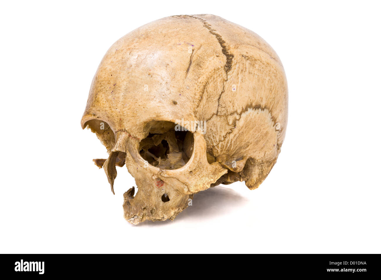 Un vecchio jawless Scull umano isolato su bianco Foto Stock