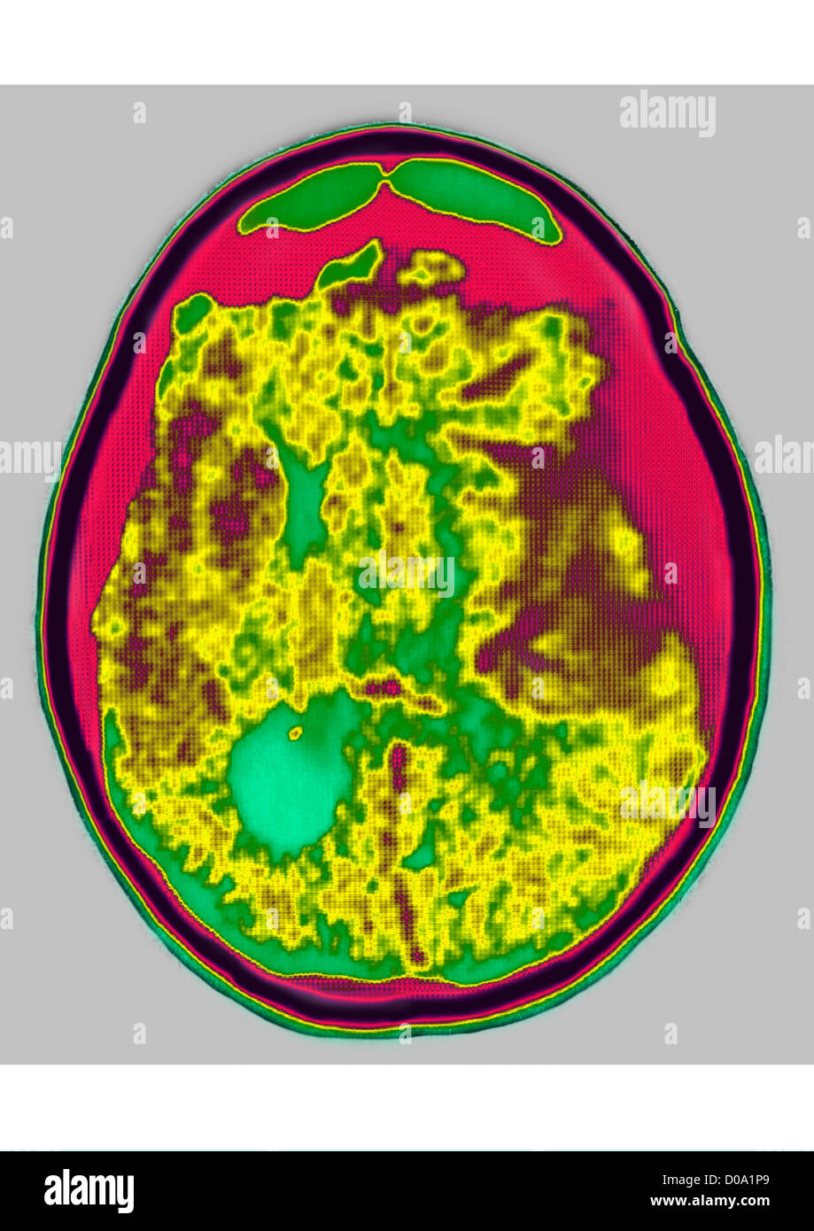 Emorragia, scansione cerebrale Foto Stock
