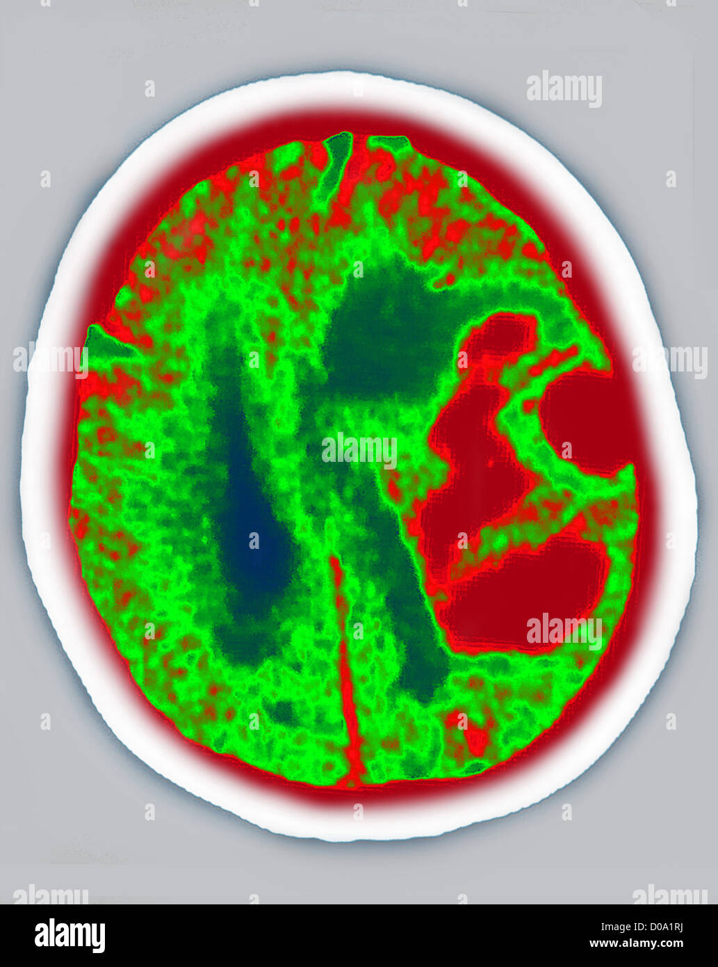 Emorragia, scansione cerebrale Foto Stock