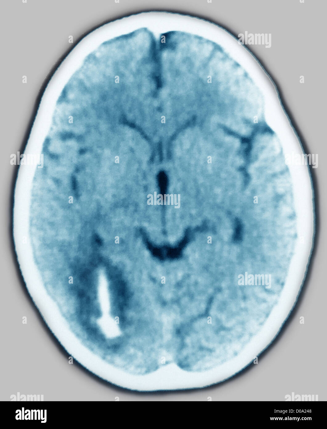 Emorragia, scansione cerebrale Foto Stock