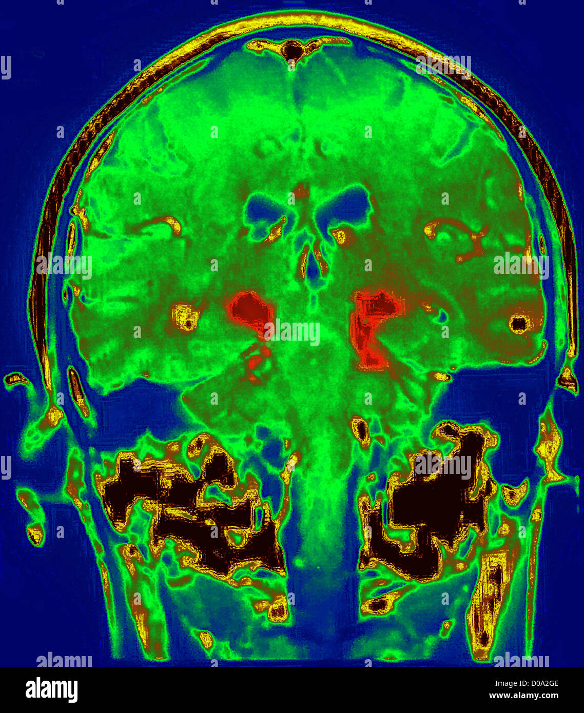 Il Morbo di Parkinson, MRI Foto Stock
