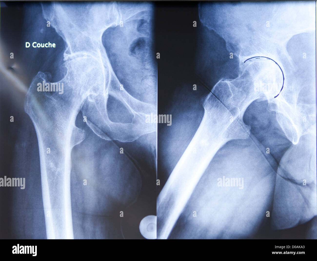 Protesi dell'anca, chirurgia Foto Stock