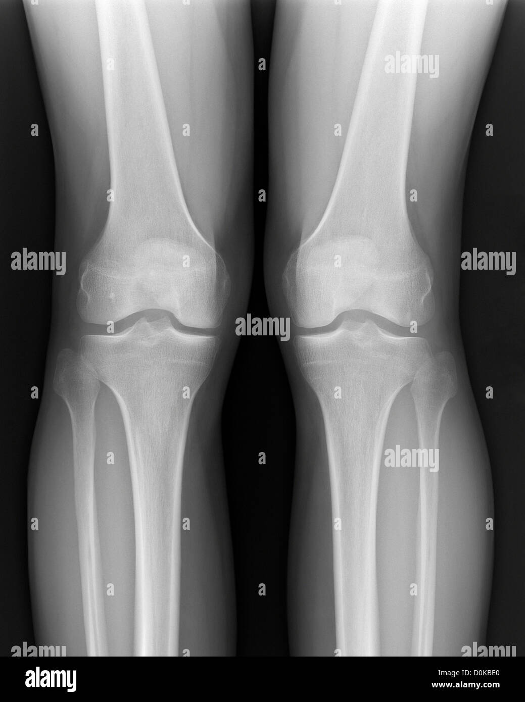 Un x-ray gambe umane ginocchia femore (o femore) incontro perone (la gamba inferiore) osseo della tibia. rotula ginocchio (cap) è la base delle ombre Foto Stock