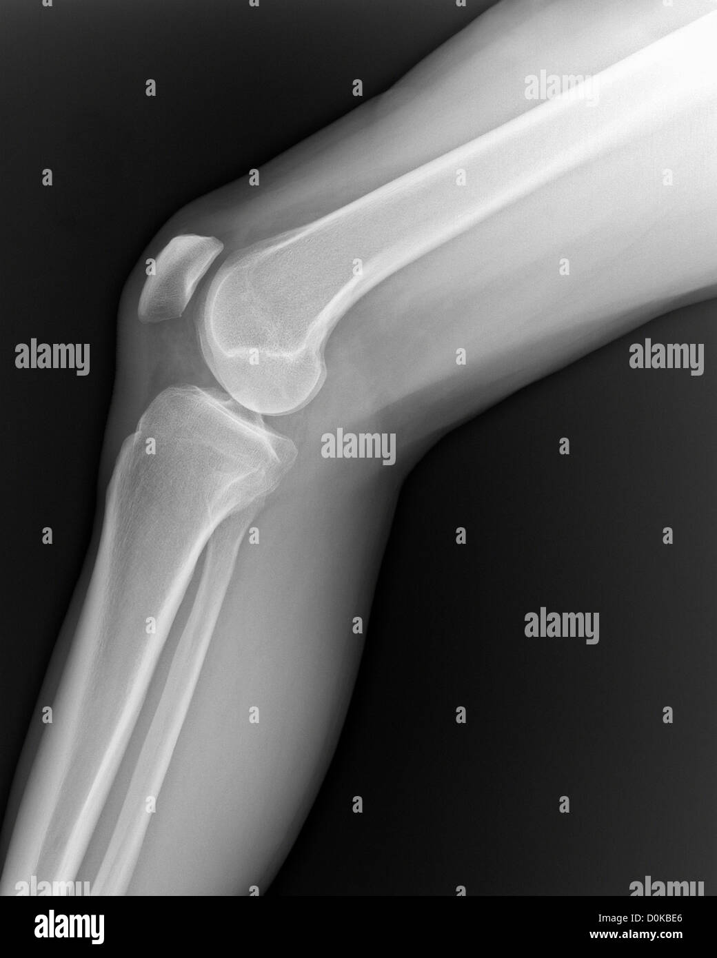Un x-ray gamba umana ginocchio visto lato in posizione seduta femore (o femore) incontro perone (la gamba inferiore) osseo della tibia. patella Foto Stock