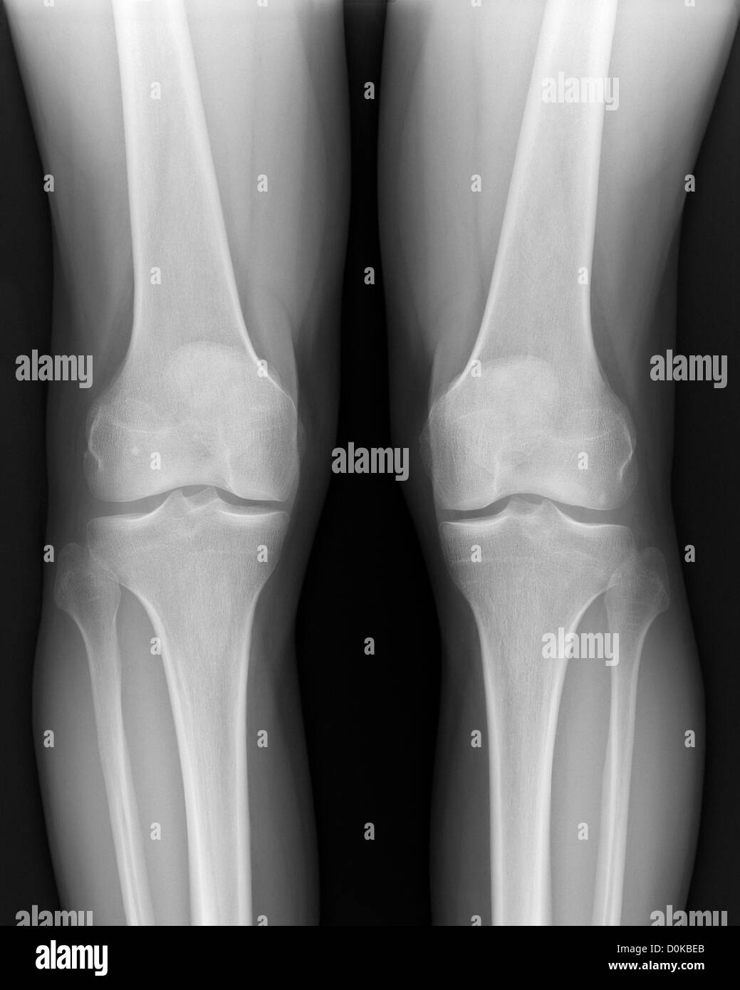 Un x-ray gambe umane ginocchia femore (o femore) incontro perone (la gamba inferiore) osseo della tibia. rotula ginocchio (cap) è la base delle ombre Foto Stock