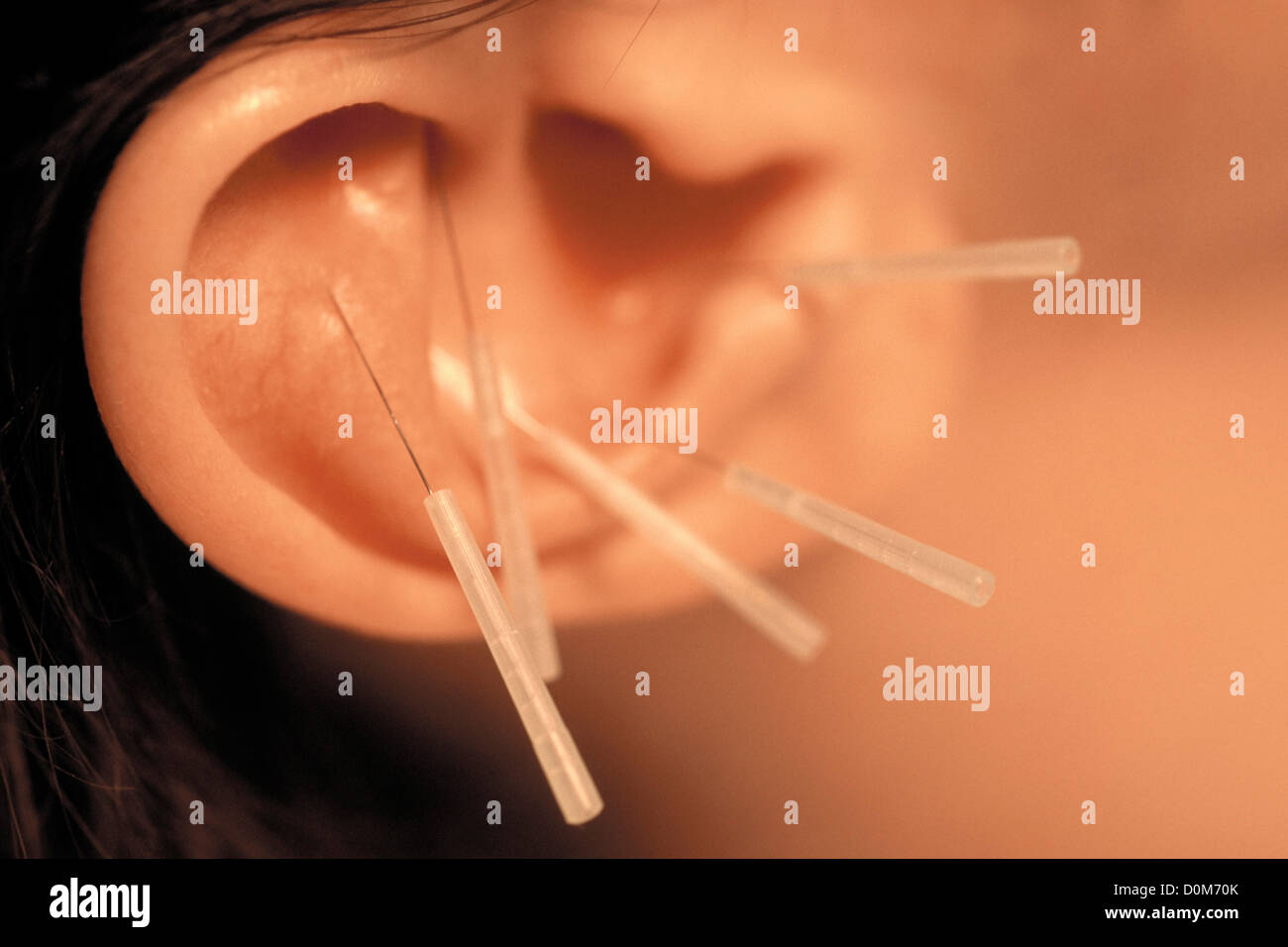 Close-up di aghi di agopuntura nell'orecchio del paziente Foto Stock