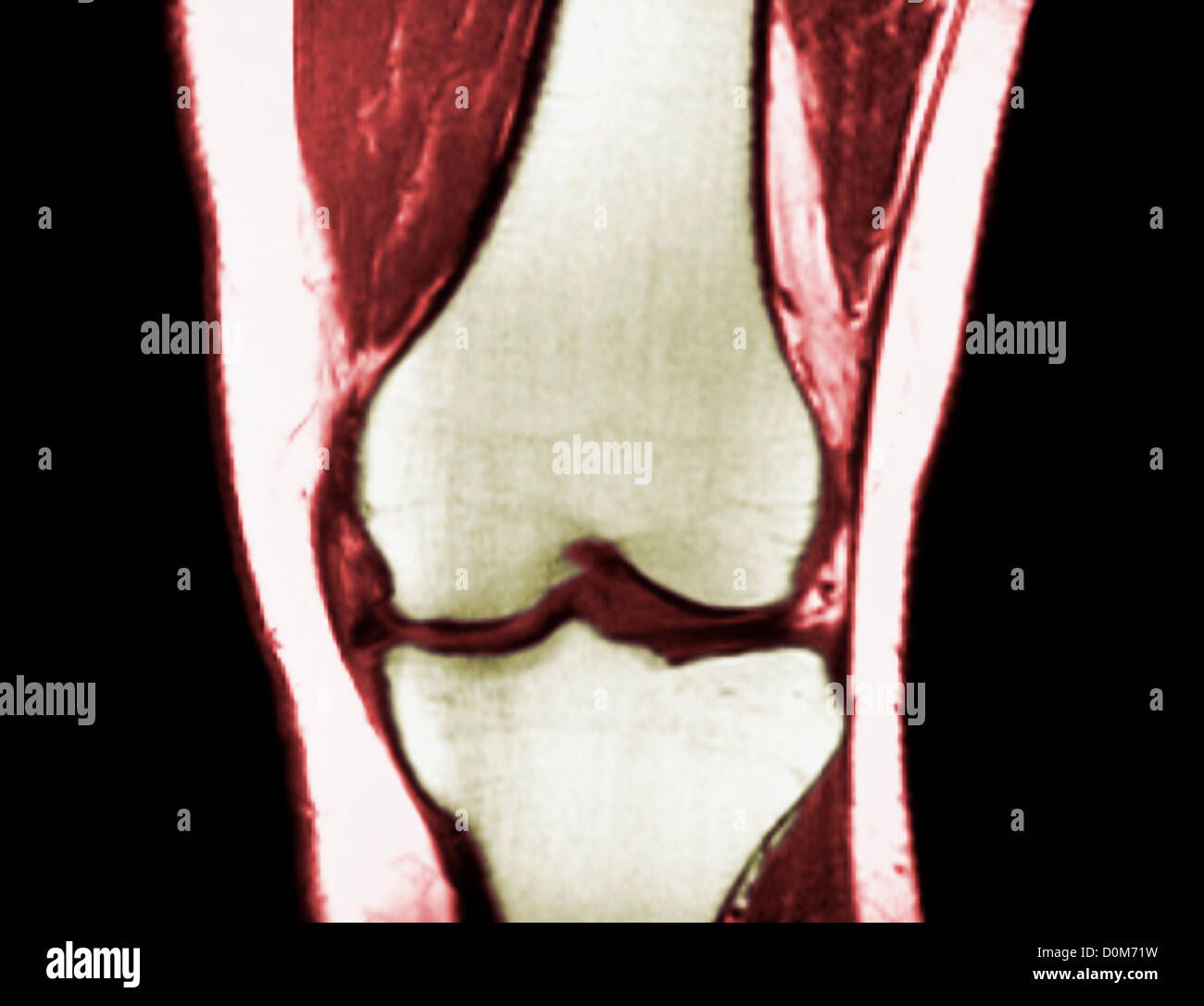 MRI scan del ginocchio sinistro, vista frontale che illustra un menisco  mediale strappare Foto stock - Alamy