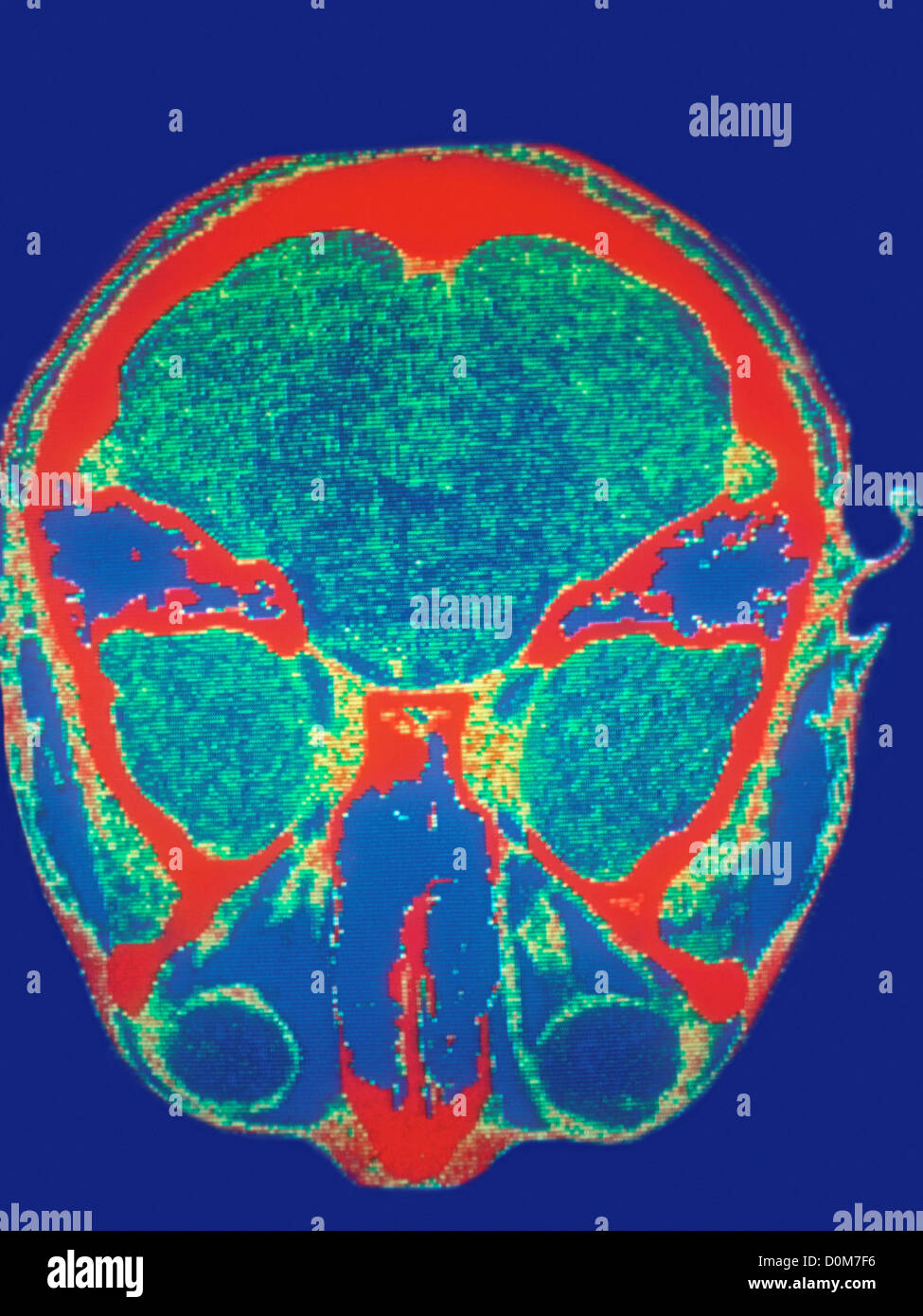 CAT Scan del nervo ottico lesione Foto Stock