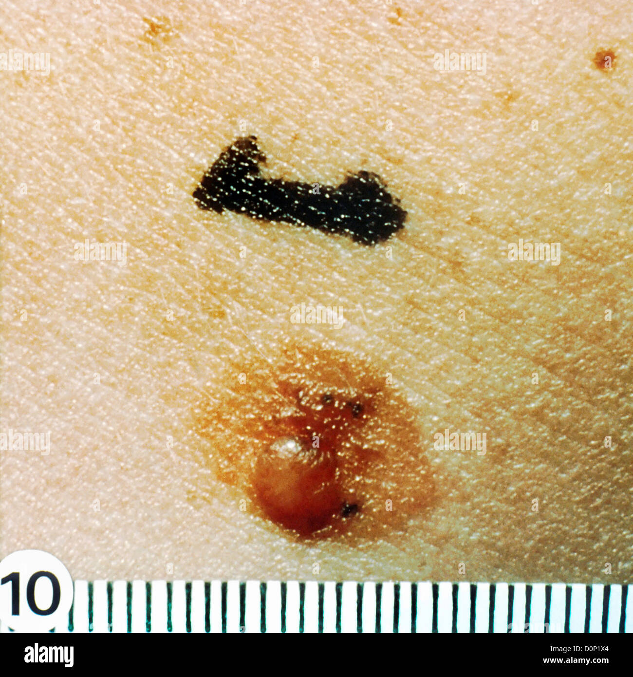 Questa mole ha caratteristica "l'uovo fritto' aspetto papula eccentrico è perfettamente nevo ordinario. Diagnosi istologica Foto Stock