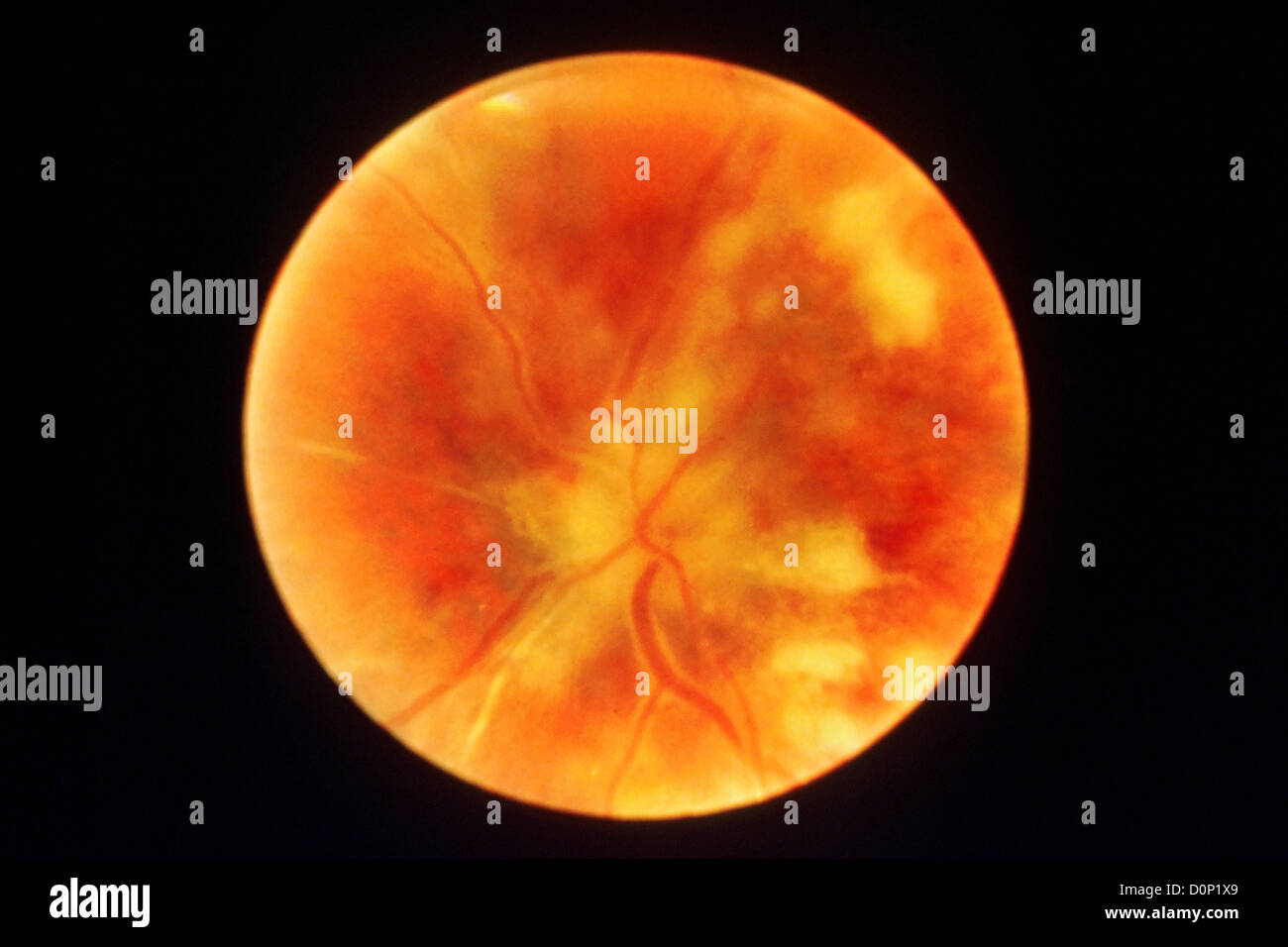 Una fotografia occhio posteriore o la retina di pazienti con AIDS chorioretinitis che è infiammazione retina, coroide (pigmentato sottile rivestimento vascolare Foto Stock