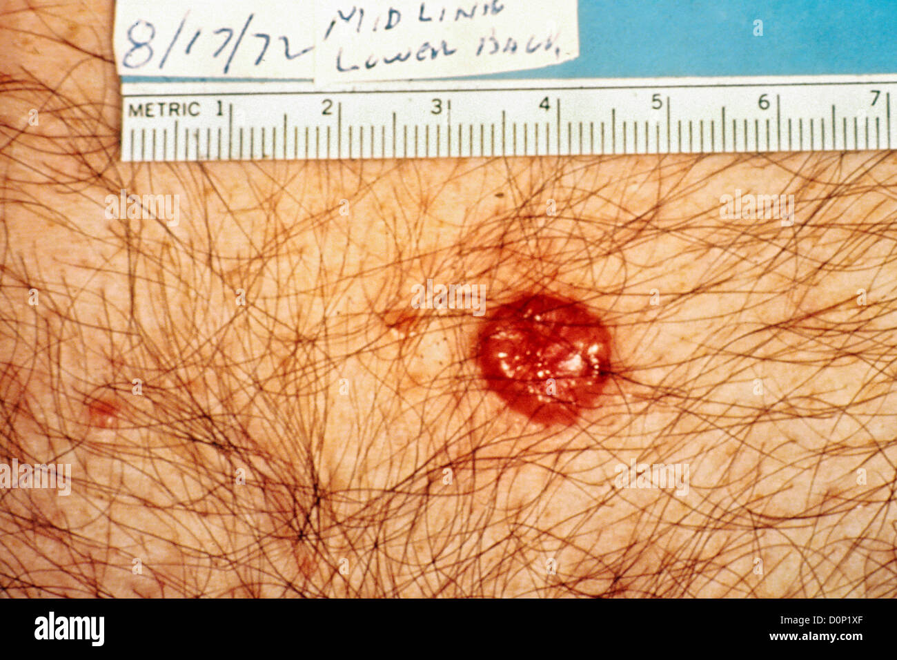 Un carcinoma basocellulare si presenta come piccolo rossiccio/marroncina papula spesso telangiectatic vasi sanguigni. Può apparire transluscent Foto Stock
