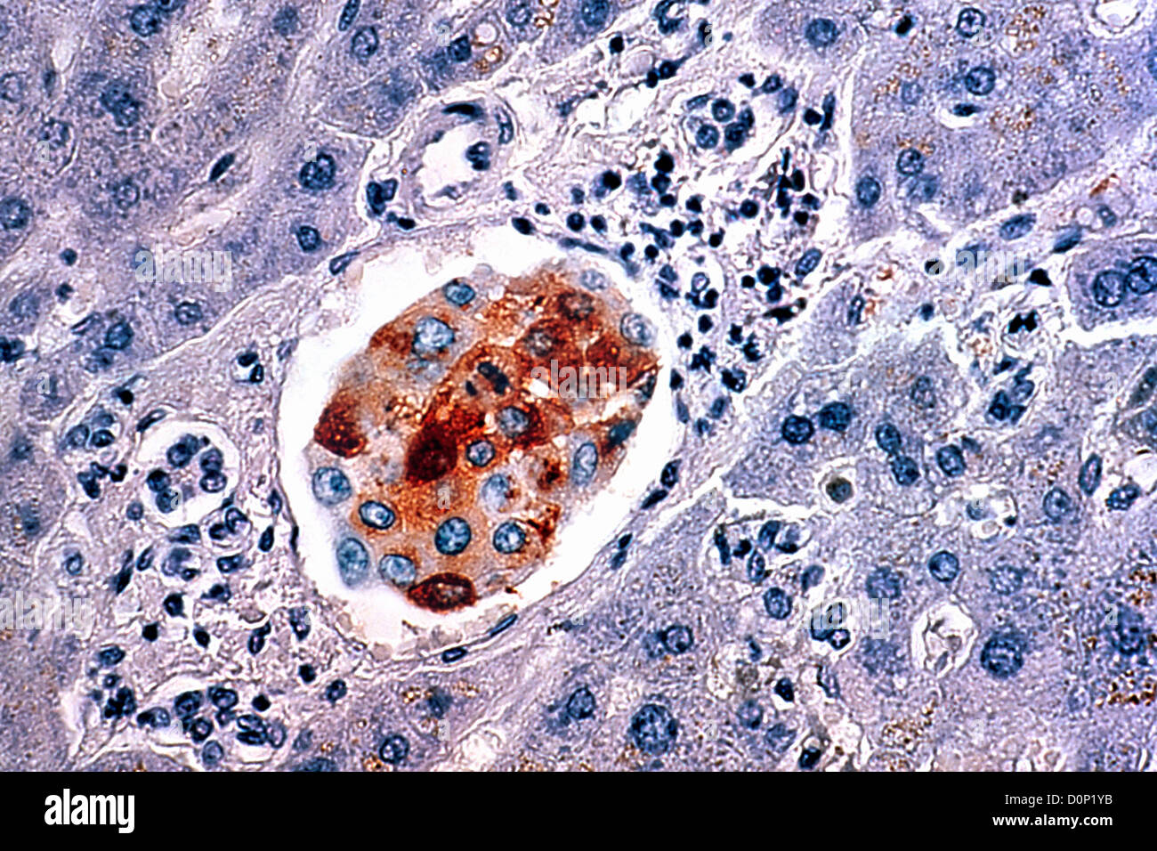 Queste patologie maligne di cellule di cancro della mammella ha formato metastasi del fegato. cancro cluster-cellule il loro colore marrone-citoplasma di colorazione è raffigurato Foto Stock