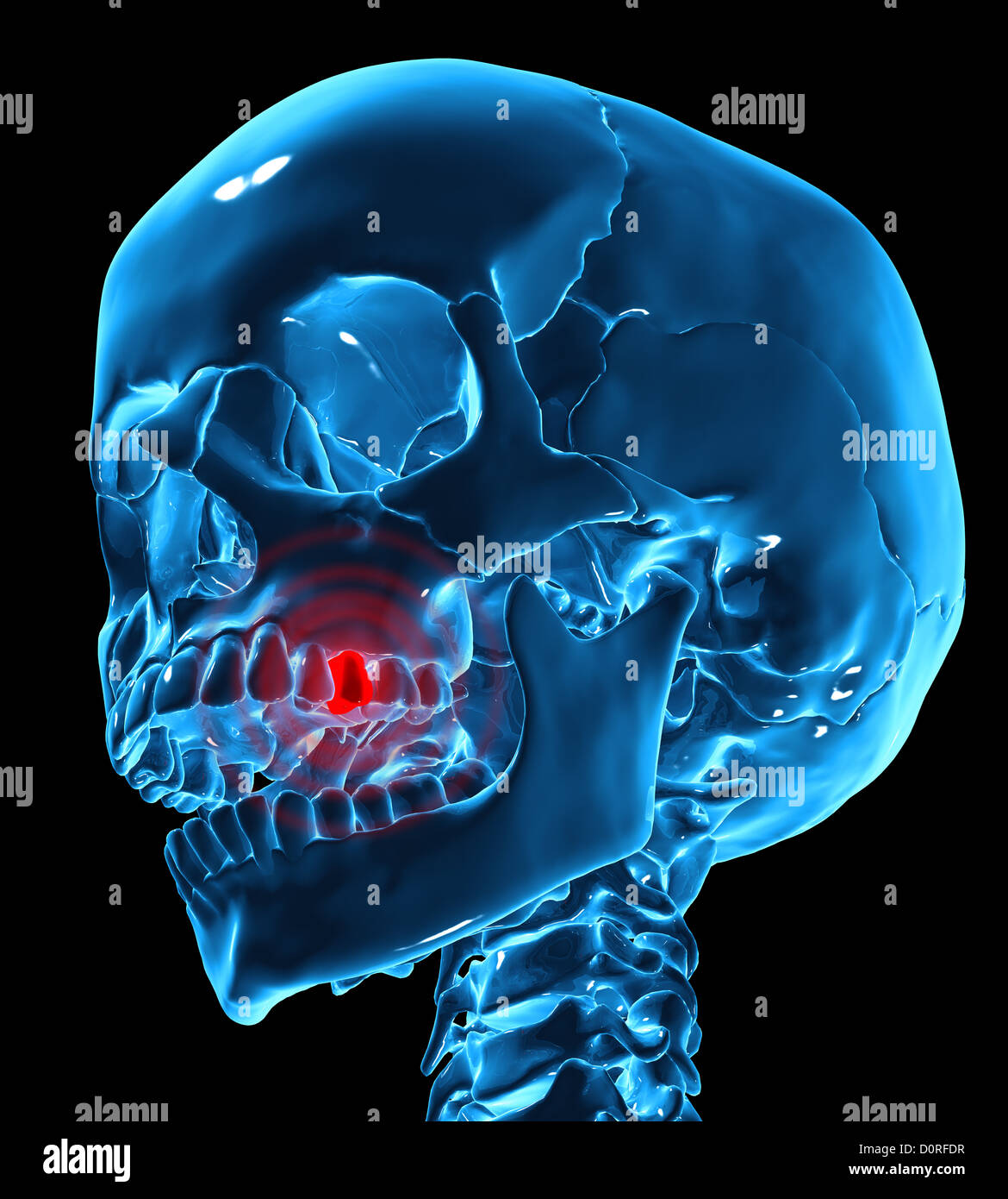 Mal di denti Illustrazione medica Foto Stock
