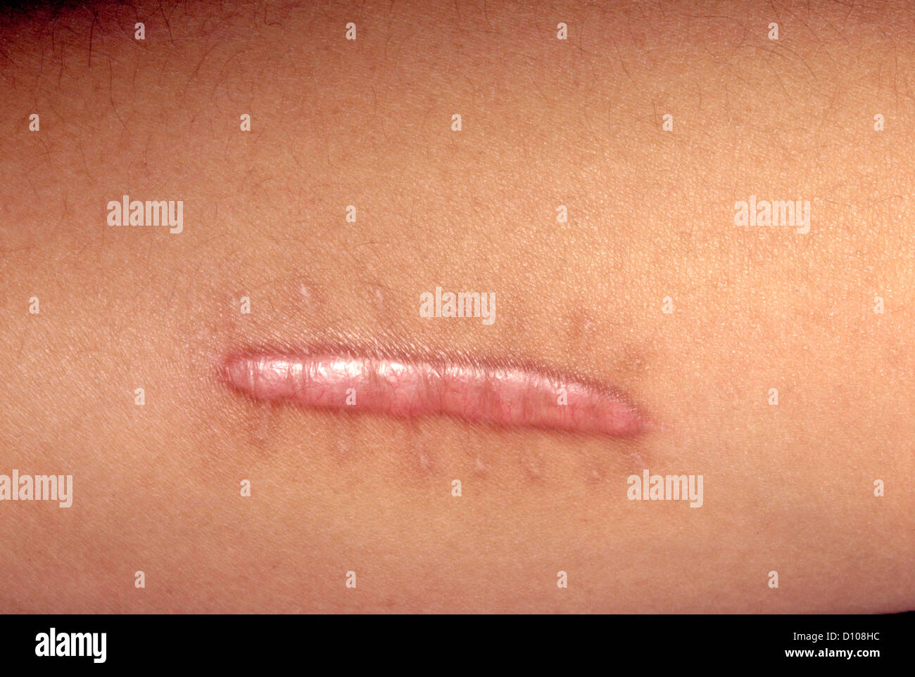 CICATRICE CHELOIDE Foto Stock