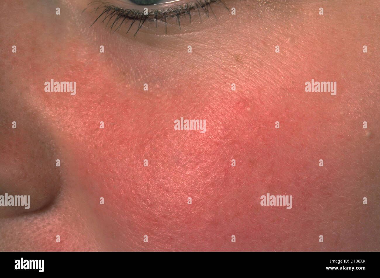 Dermatite seborroica Foto Stock