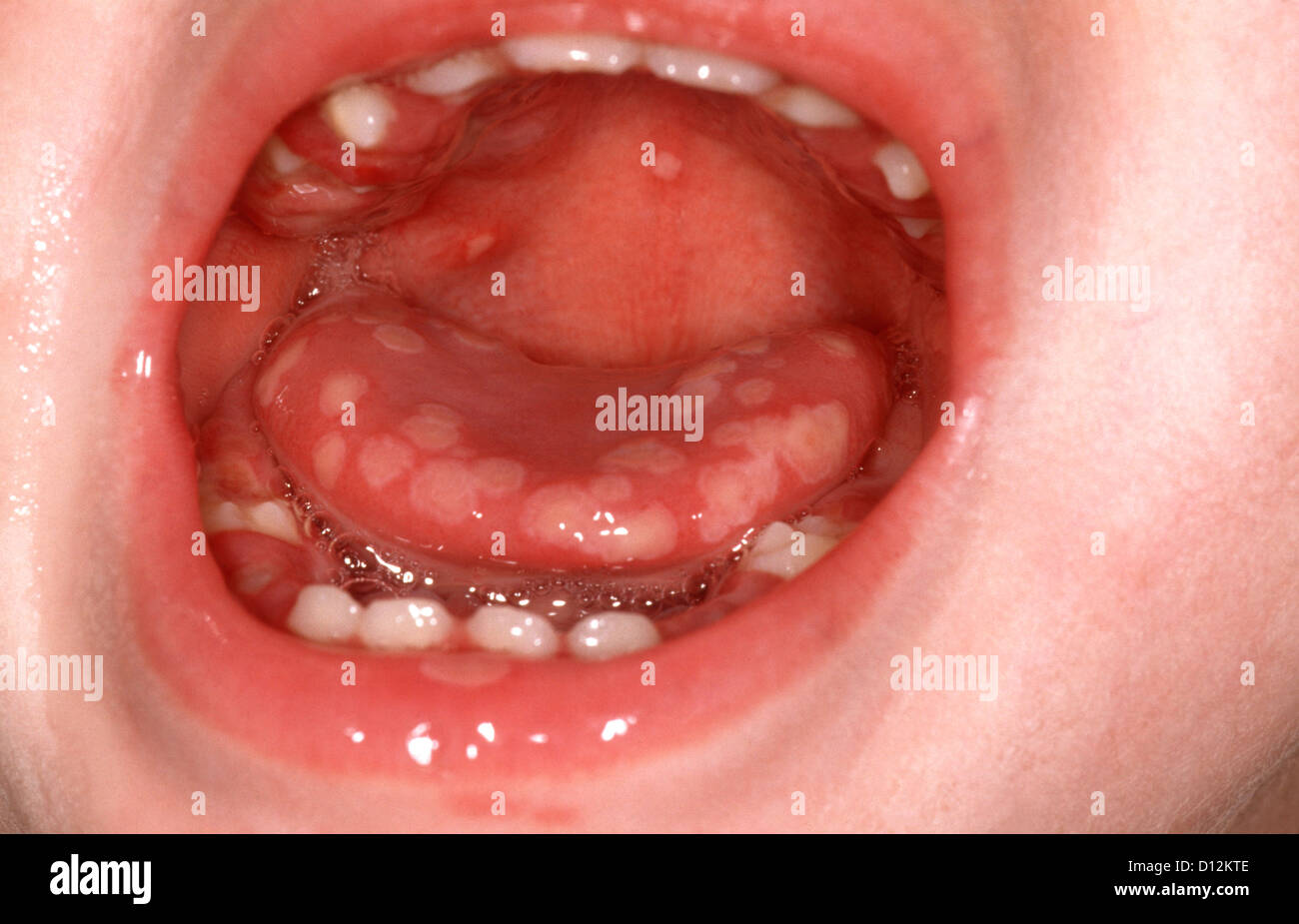 La somministrazione orale di herpes simplex Foto Stock