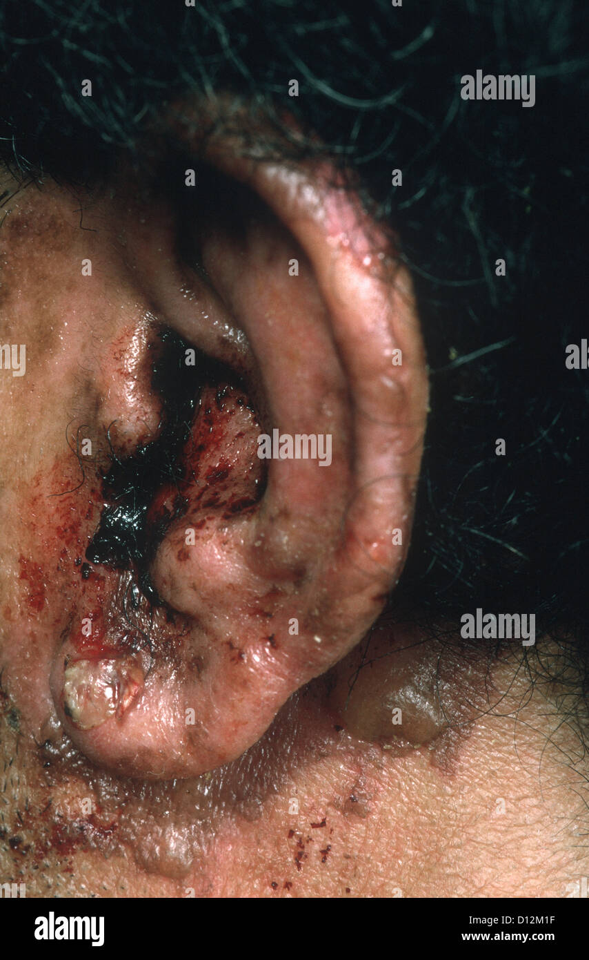 Grave otite esterna Foto Stock