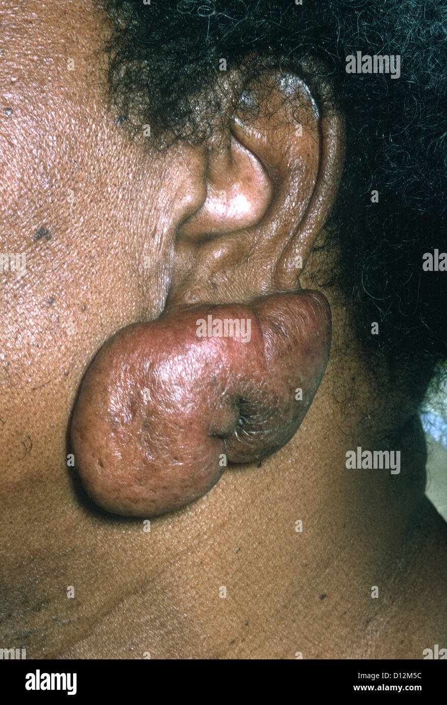 Cheloide del lobo Foto Stock