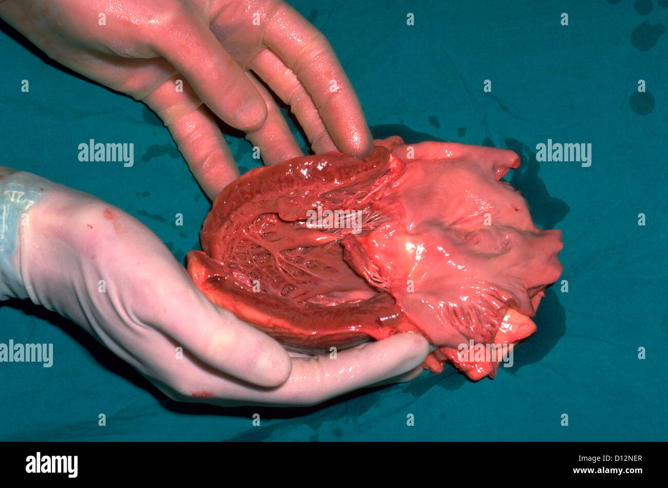 Cuore esemplare che mostra l'infarto acuto del miocardio e rottura di muscolo papillare Foto Stock