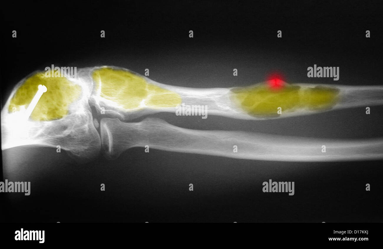 X-ray di ulna e humerous con displasia fibrosa Foto Stock