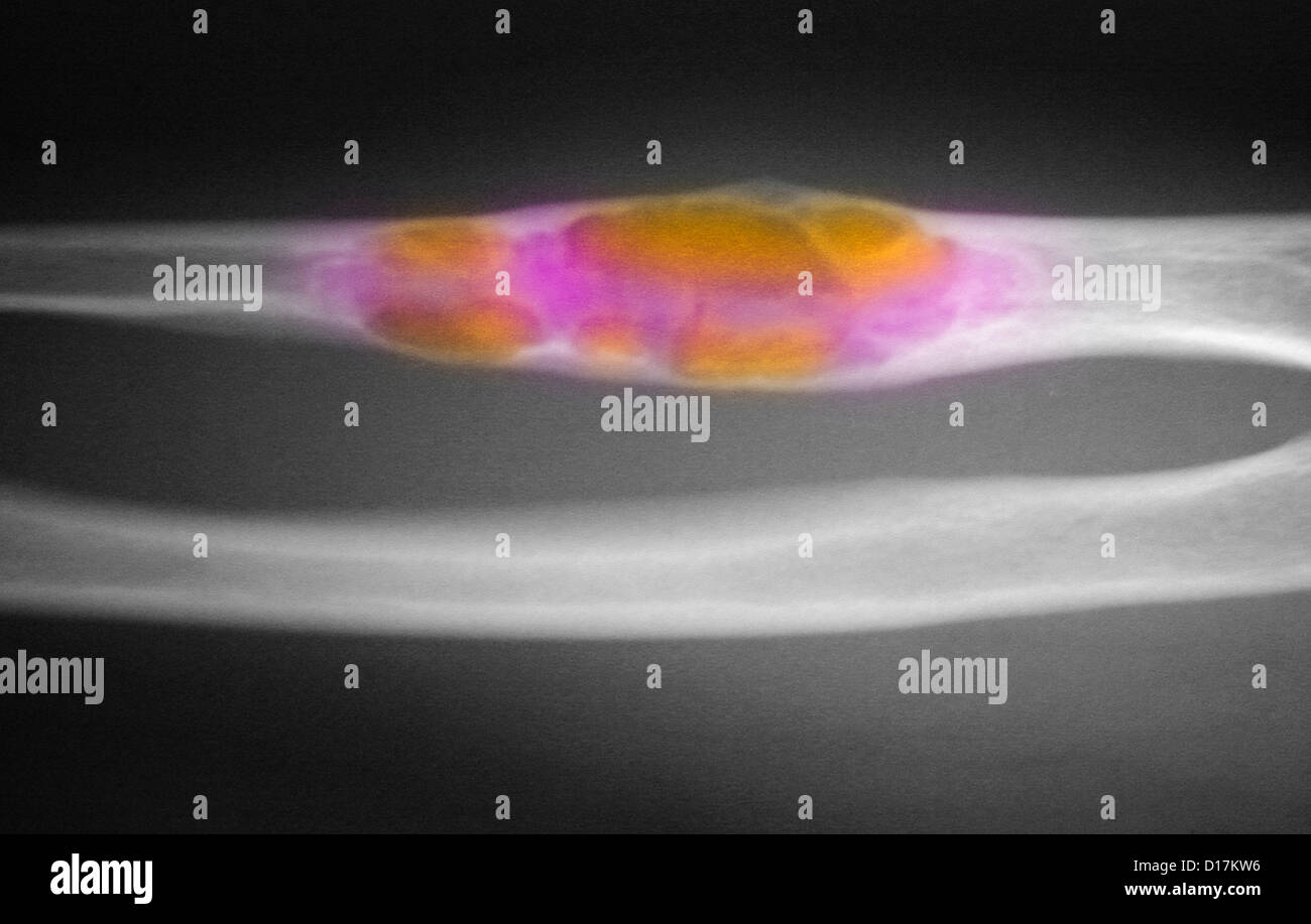 X-ray di ulna e humerous con displasia fibrosa Foto Stock
