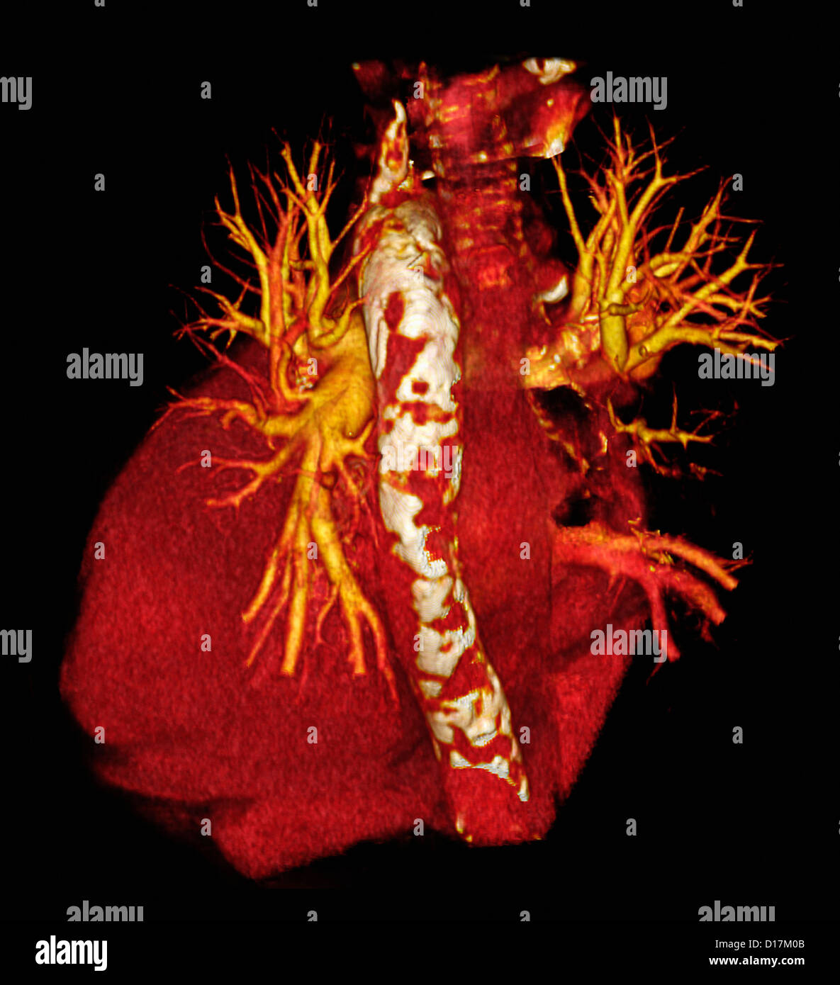 Scansione TC del cuore con calcific aorta Foto Stock